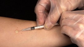 Diagnosis of TB becomes difficult in Bihar, Centre writes to state for exemption Diagnosis of TB becomes difficult in Bihar, Centre writes to state for exemption